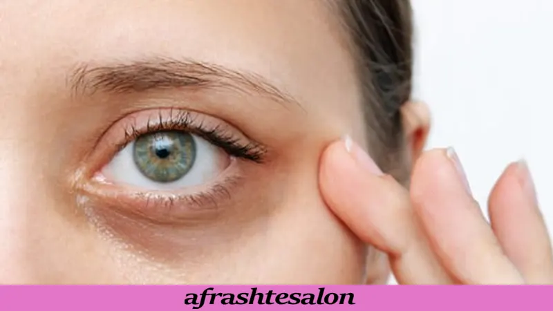 روش‌های طبیعی برای از بین بردن تیرگی دور چشم